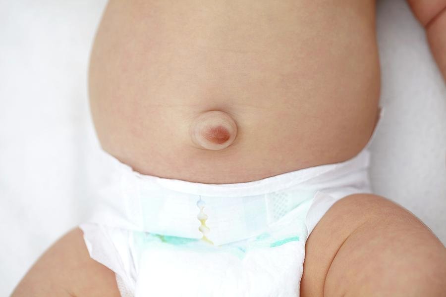 Umbilical Hernia