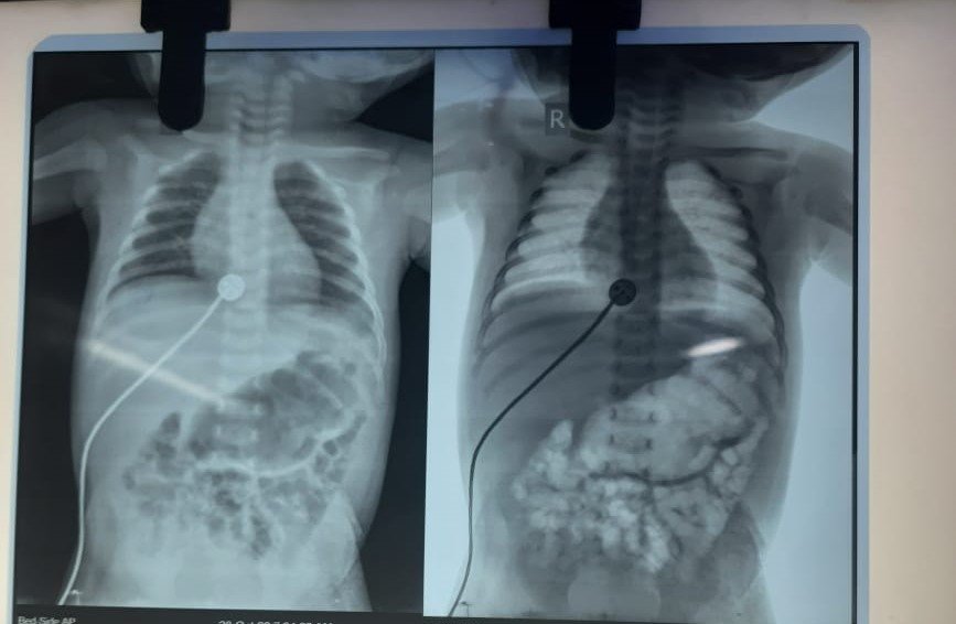 Meconium Ileus