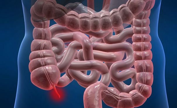 Appendicitis