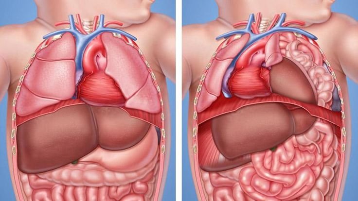 Congenital Diaphragmatic Hernia