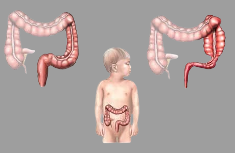 Hirschsprung's Disease