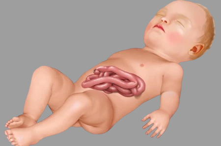 Intestinal Atresia