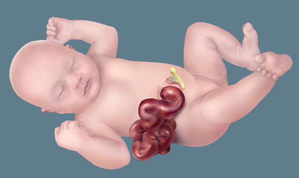 Gastroschisis