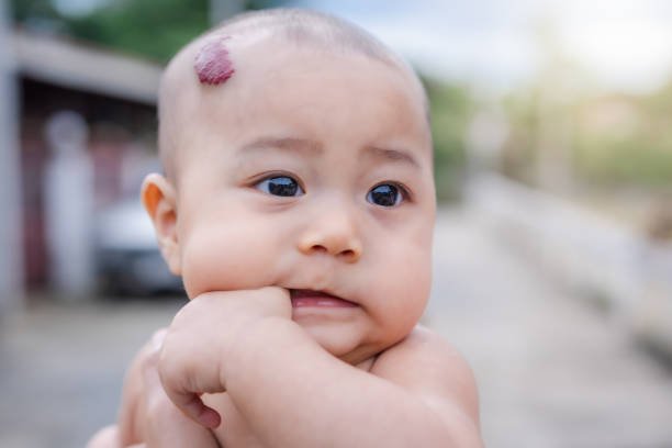 Vascular Malformations