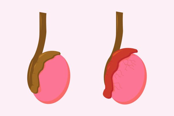 Epididymitis & Orchitis