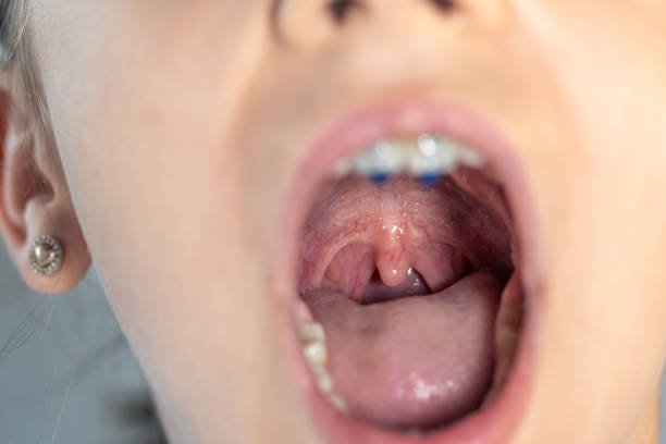Thyroglossal Duct Cyst Excision