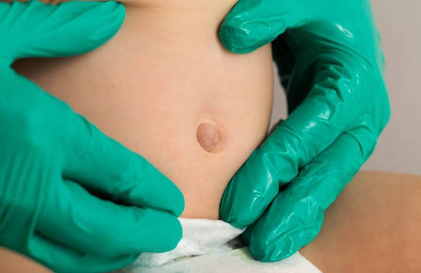 Choledochal Cyst