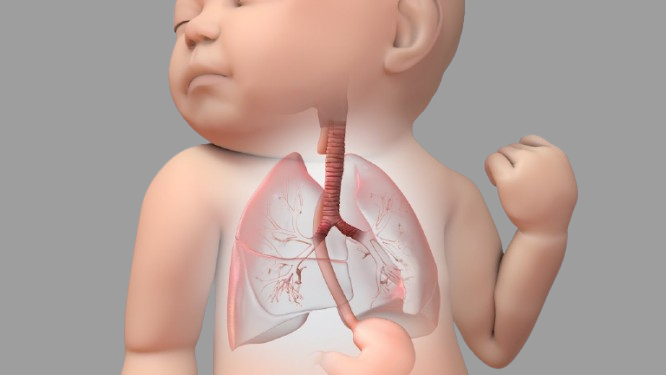 Tracheoesophageal Fistulas