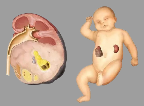Wilms Tumor
