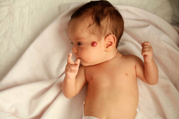 Soft Tissue Tumor