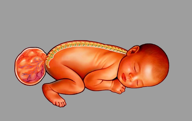 Case Report Teratoma
