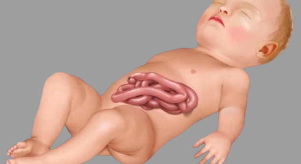 gastroschisis-3-removebg-preview