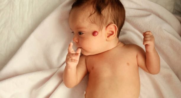 Hemangioma on the face of a baby Hemangioma on the face of a baby